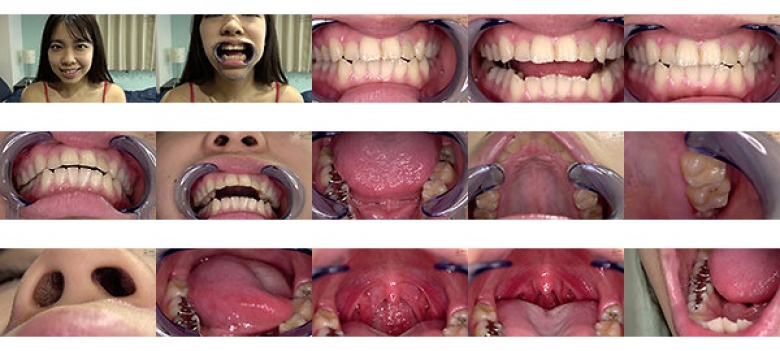 Tooth Fetish-Observation of uvula in teeth and mouth-Kaede Nagano:SampleImage